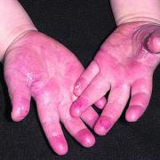 A case of scarlet fever has been confirmed at a Herefordshire  primary school. File picture