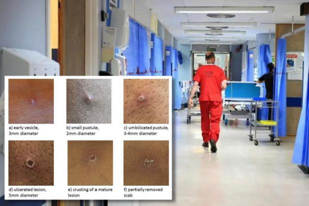 CASES: Monkeypox cases have risen in the UK. Picture: UKHSA