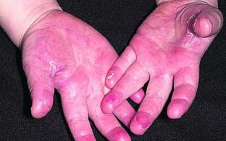 A case of scarlet fever has been confirmed at a Hereford primary school. File picture